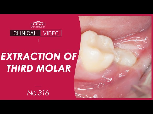 [ENG] Extraction of Horizontal Lt. Mn Third Molar [Dr. Cho Yongseok]