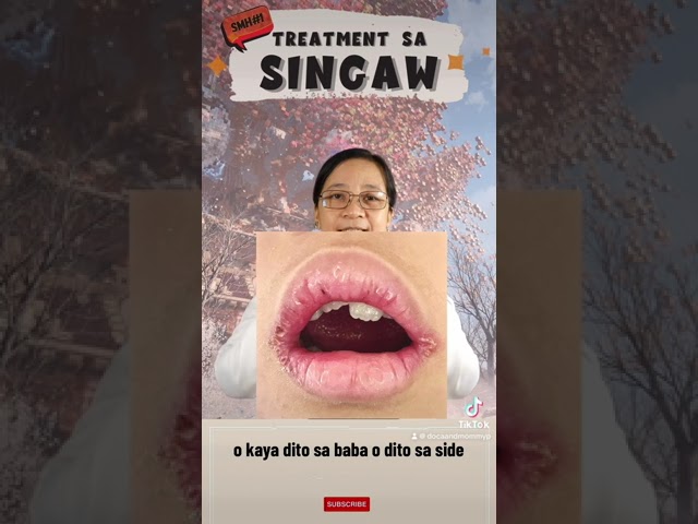 PAANO GAMUTIN ang SINGAW sa BATA