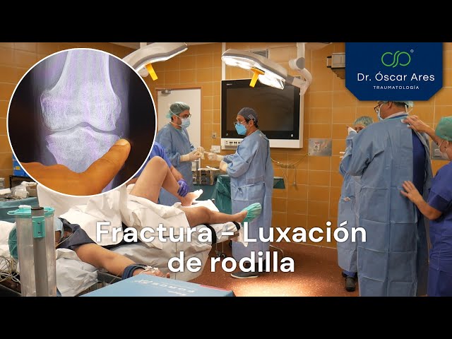 Fractura - Luxación de rodilla, tratamiento con prótesis de charnela - Dr. Ares