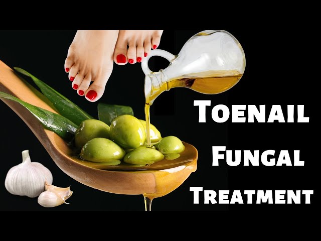 Toenail Fungus | Toenail Fungus Treatment and #toenailfungus #homeremedies #fungus