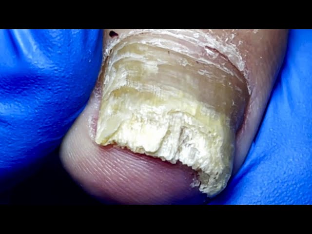 The Deteriorated Pattern On The Toenails, Cut Off All The Fungi【Pedicure Master Lin Jun】