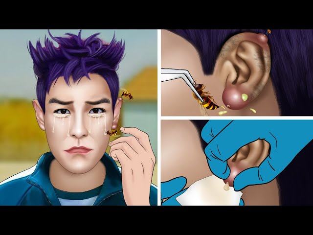 T.O.P participates in Squid Game and the ending | Treatment of bee stings in the ear | ASMR