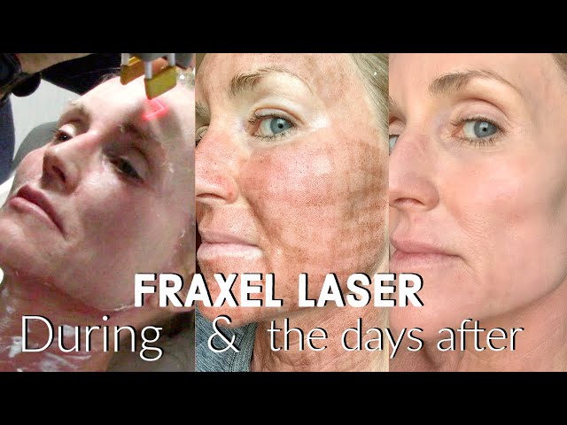 My FRACTIONAL CO2 LASER Experience | The FULL Treatment & the DAYS following | BEFORE & AFTER Fraxel