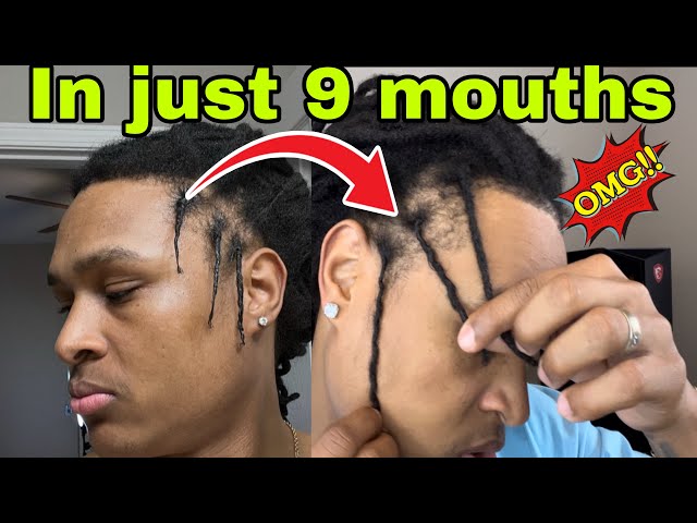 📌this is what I did ☝️my sides dreads grew in just 9 mouths