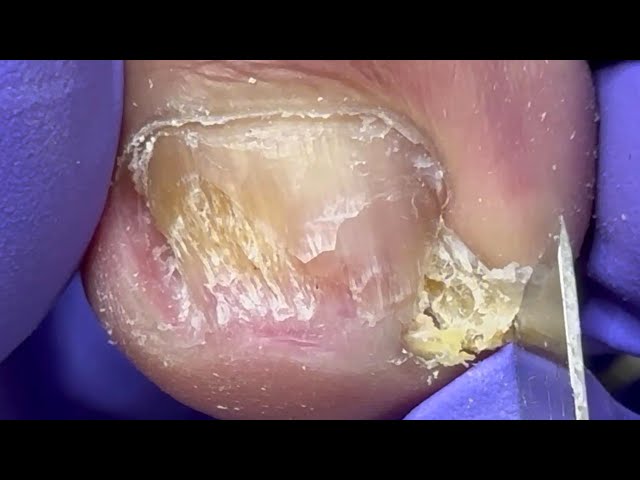 Huge lumpy onychomycosis at the front of the toenail!【Doctor Liu Pedicure】