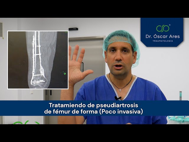 Pseudoartrosis de fémur. Tratamiento mínimamente invasivo. - Dr. Ares