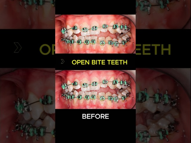 Braces progess - Open bite teeth #braces #orthodontist #dentist #brackets