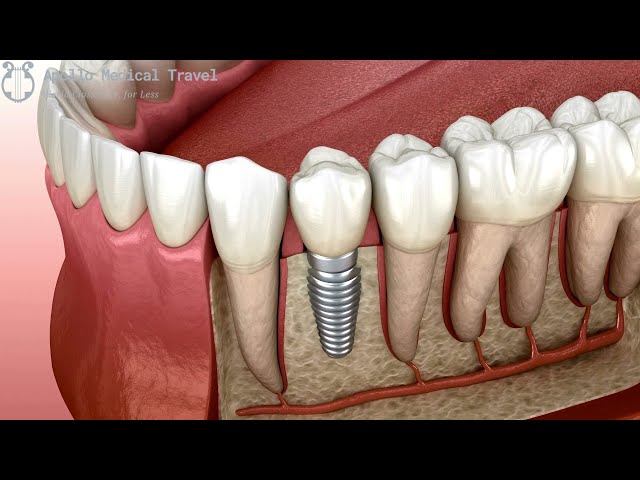 Animated Dental Implant Procedure | Apollo Medical Travel