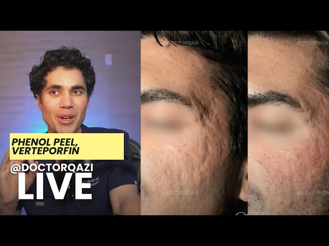 Dr. Qazi discusses Phenol Peel, Verteporfin, Silicone Tape | Dr. Qazi Unsponsored Live | 2.5.2025