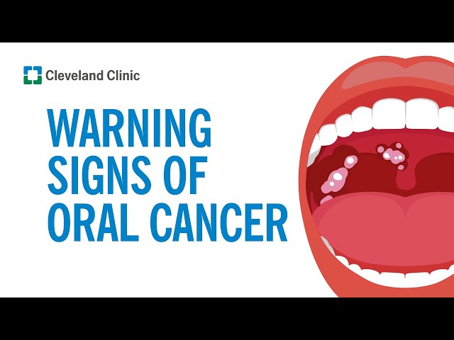 How to Screen Yourself for Oral Cancer