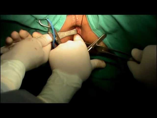 High Peri Anal Fistula- Ano- Rectal Surgery Video- Dr Rajnish Talwar