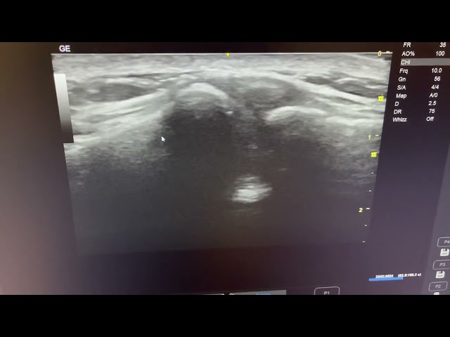 MSK ultrasound shoulder - Demonstration AC joint