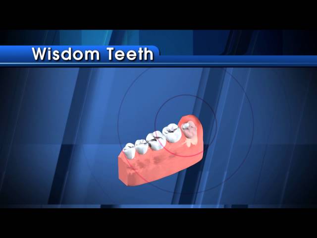 Wisdom Teeth