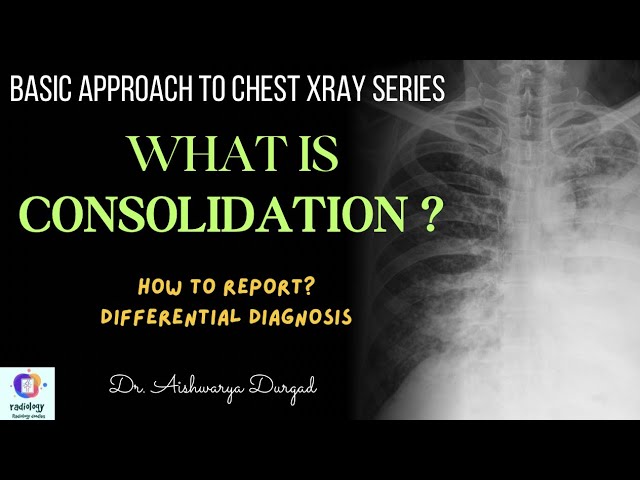 What is CONSOLIDATION on Chest XRay? Basic concepts and Differential diagnosis & How to report