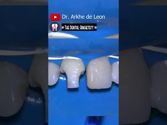 Amazing Replacement of Old Anterior Restoration. #dental #dentist  #toothrestoration #4k