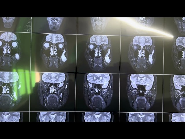 CHEEK HAEMANGIOMA //RARE TUMOUR//TRANSORAL EXCISION