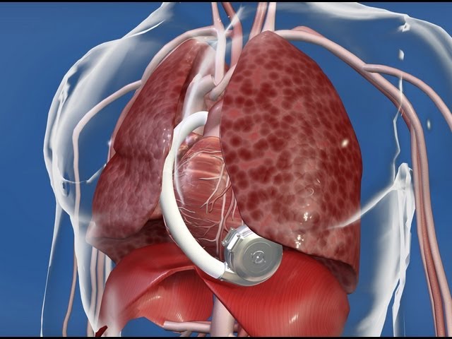 Your Health: Stanford's Dipanjan Banerjee, MD, Discusses Left Ventricular Assist Device (LVAD)