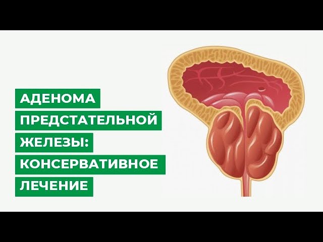 Аденома предстательной железы: консервативное лечение