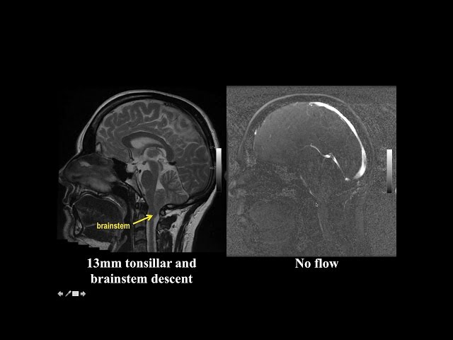 Cine MRI for Chiari I Malformation