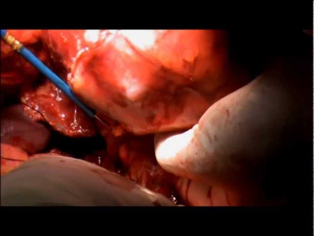 Radical Nephrectomy Left- Locally Advanced Bulky Tumor- Bloodless Whitefield Flank Access- R Talwar