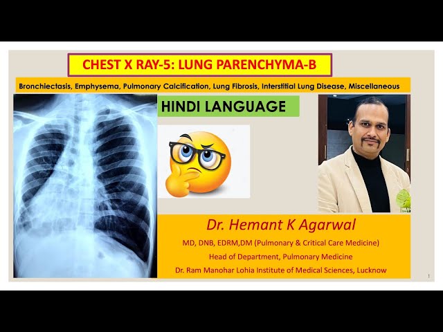 Radiology- Chest X Ray:5, (HINDI) Bronchiectasis, Emphysema, ILD, Pulmonary Edema, Nodule@Dr. Hemant