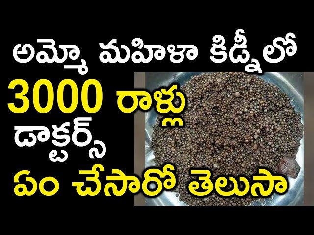 3000 stones found in women kidney || savitru concepts