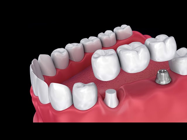 Combined dental crown and implant.