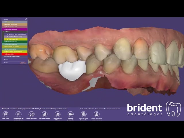 Prótesis dentales fijas | Brident Odontologos Tenerife