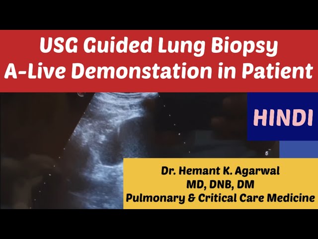 USG Guided Lung Biopsy/ Ultrasound Guided Lung Biopsy- A Live Demonstration on Patient (HINDI)