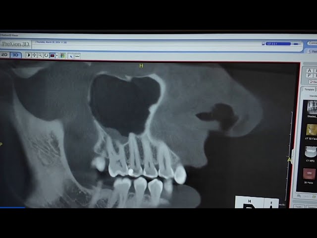 Feeling like you always have a toothache? It may just be sinus pressure