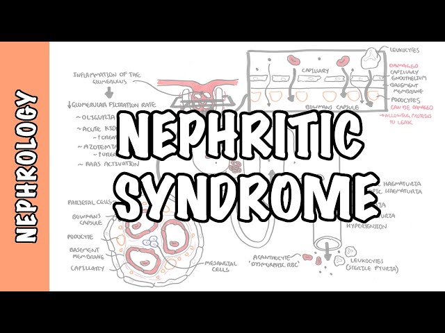 Nephritic Syndrome - classification, pathophysiology, treatment (RPGN, ANCA, Immune complex)