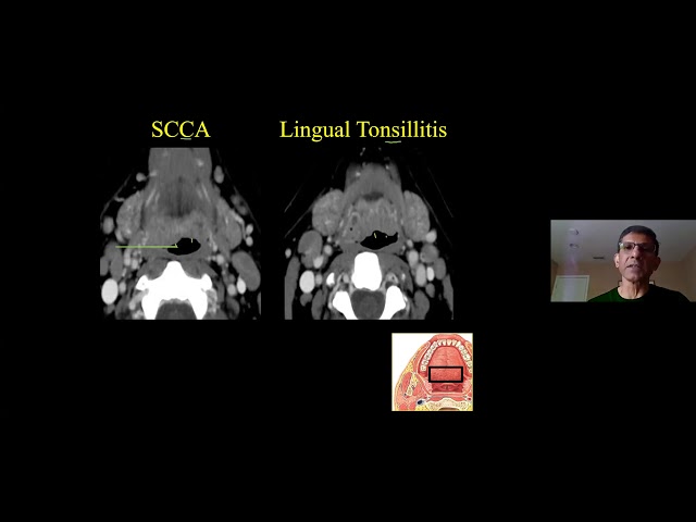 Anatomy & Pathology of the Oral Cavity & Oropharynx Dr Suresh Mukherji - MRI Online Noon Conference