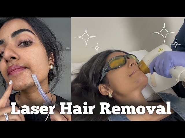 FINALLY getting Laser Hair Removal treatment on my face! Was it worth it?