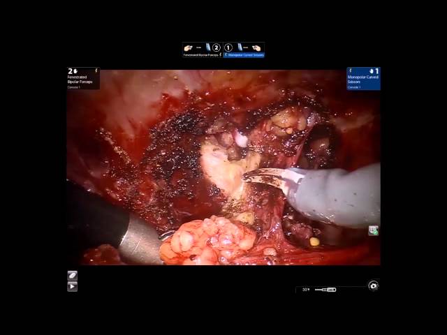 The application of robotic assisted tapp ventral hernia repair in obese patient population