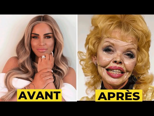 25 Actrices Célèbres dont la Chirurgie Plastique a Mal Tourné