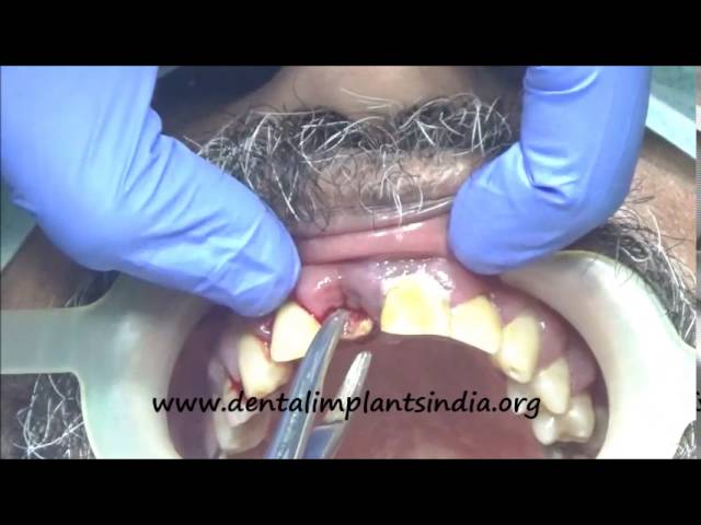 Highly infected upper central incisor-EXTRACTION AND IMMEDIATE IMPLANT SURGERY-VIDEO