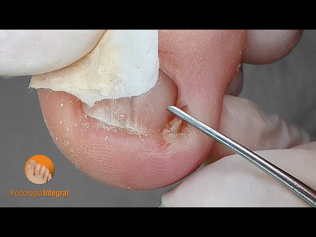 Little spicule = Challenging job! | Consequences of an incorrect cut of the toenail [Podology]