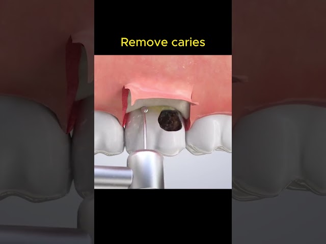 How to remove caries?