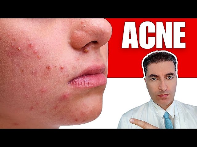 How to Cure Acne Naturally?