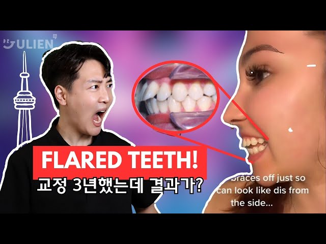 FLARED TEETH: THE ULTIMATE CURE (AND IT’S NOT EXTRACTION)