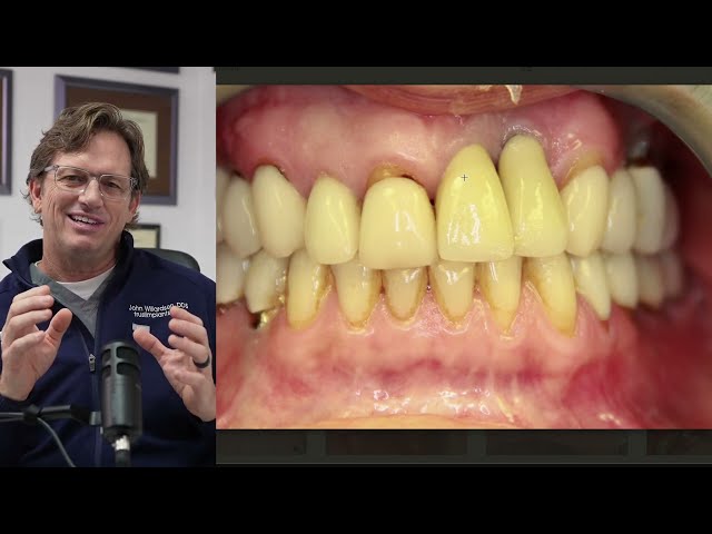 Truth: The Dental Implant Healing Process