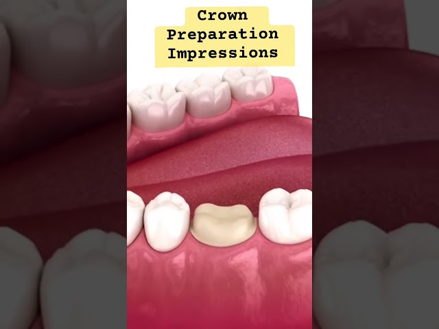 Crown preparation,Impressions