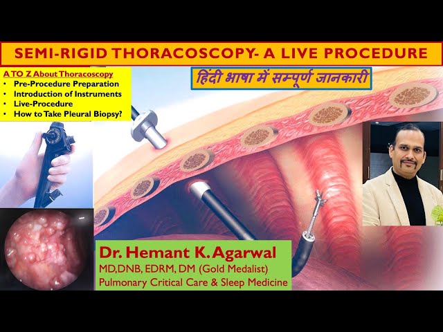 Semi Rigid Medical Thoracoscopy (हिंदी भाषा) In Undiagnosed Exudative Pleural Effusion @Dr. Hemant