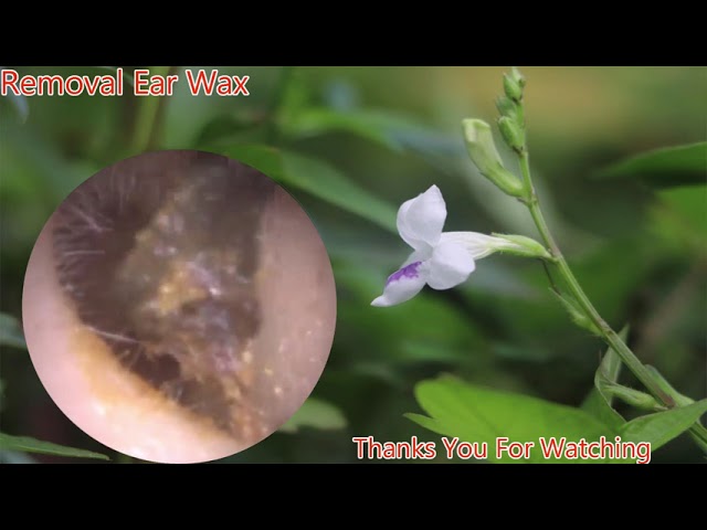 Removal of Ear Wax from Entier Ear Canal #Shorts