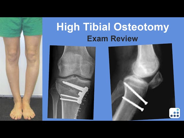 High Tibial Osteotomy Exam Review - Mark Pagnano, MD