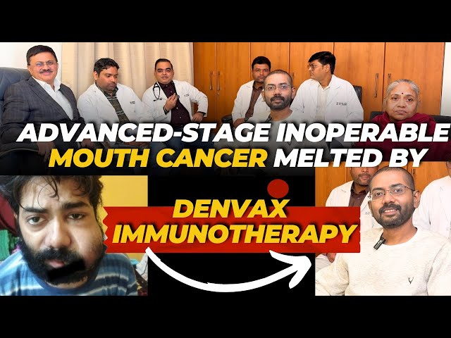 Advanced-Stage Inoperable Mouth Cancer Melted by Denvax Immunotherapy| Dr. Jamal A. Khan DENVAX