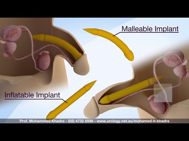 Penile Prosthesis - Professor Mohamed H Khadra