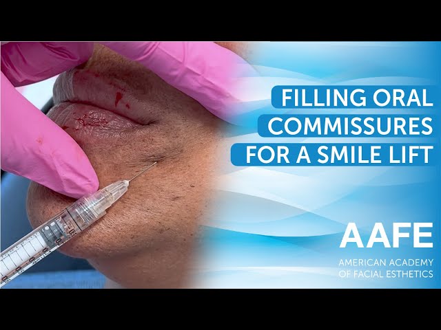 Filling Oral Commissures for a Smile Lift