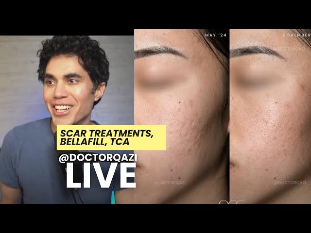 Dr. Qazi discusses Scar Treatments, Bellafill, Phenol Peels | Dr. Qazi Unsponsored Live | 2.12.2025