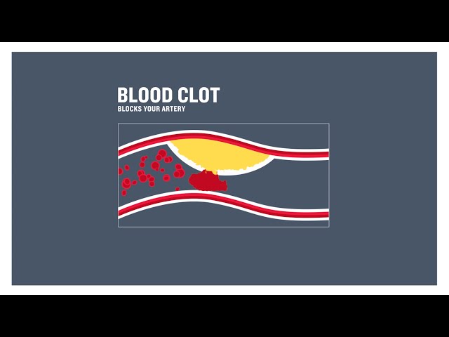 Coronary heart disease, clogged arteries and atherosclerosis